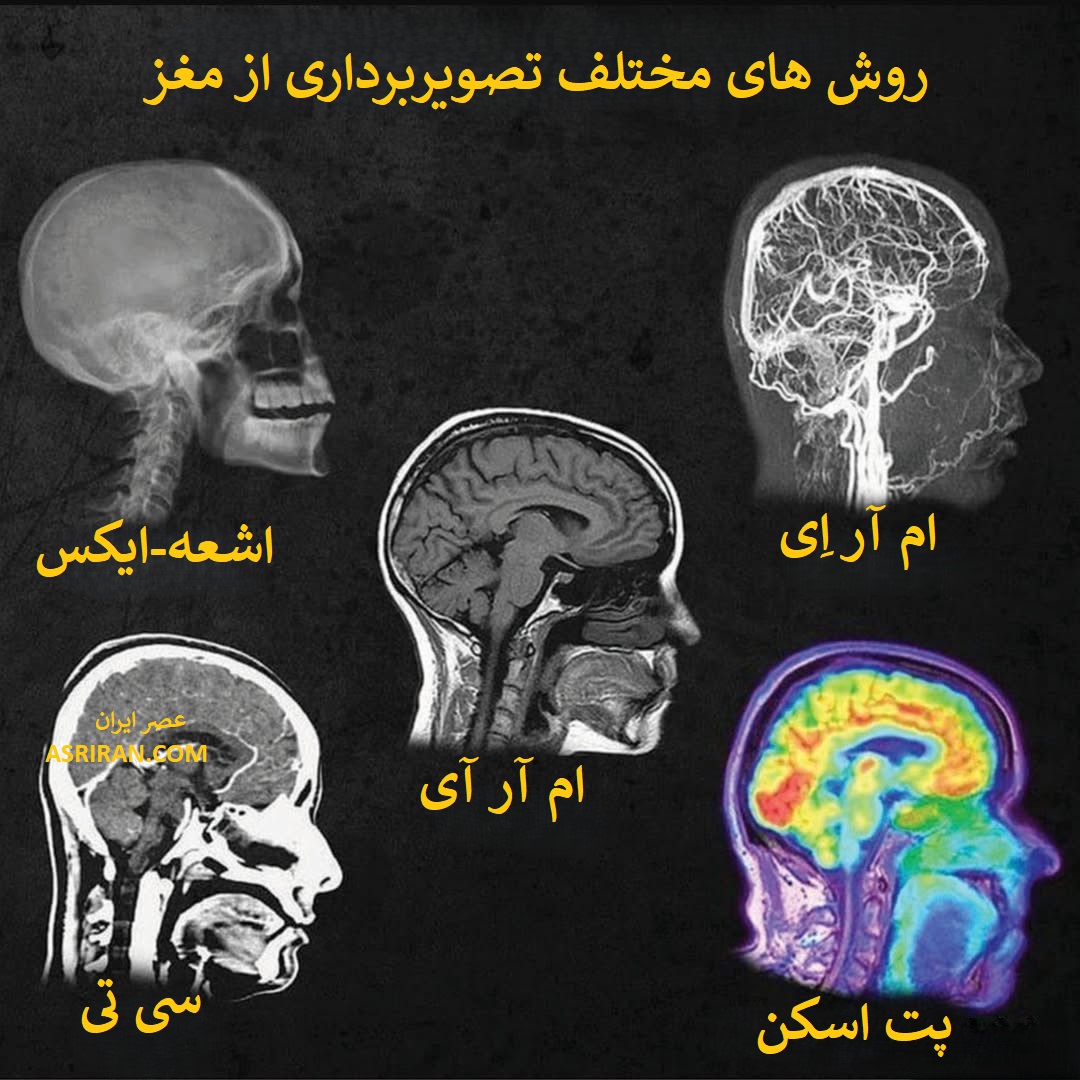 نام انواع روش هایی تصویربرداری از مغز نام انواع روش هایی تصویربرداری از مغز