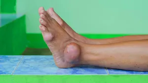 آیا سرکه سیب می‌تواند نقرس را درمان کند؟