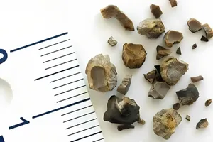 سنگ مثانه از سنگ کلیه خطرناک‌تر است؟